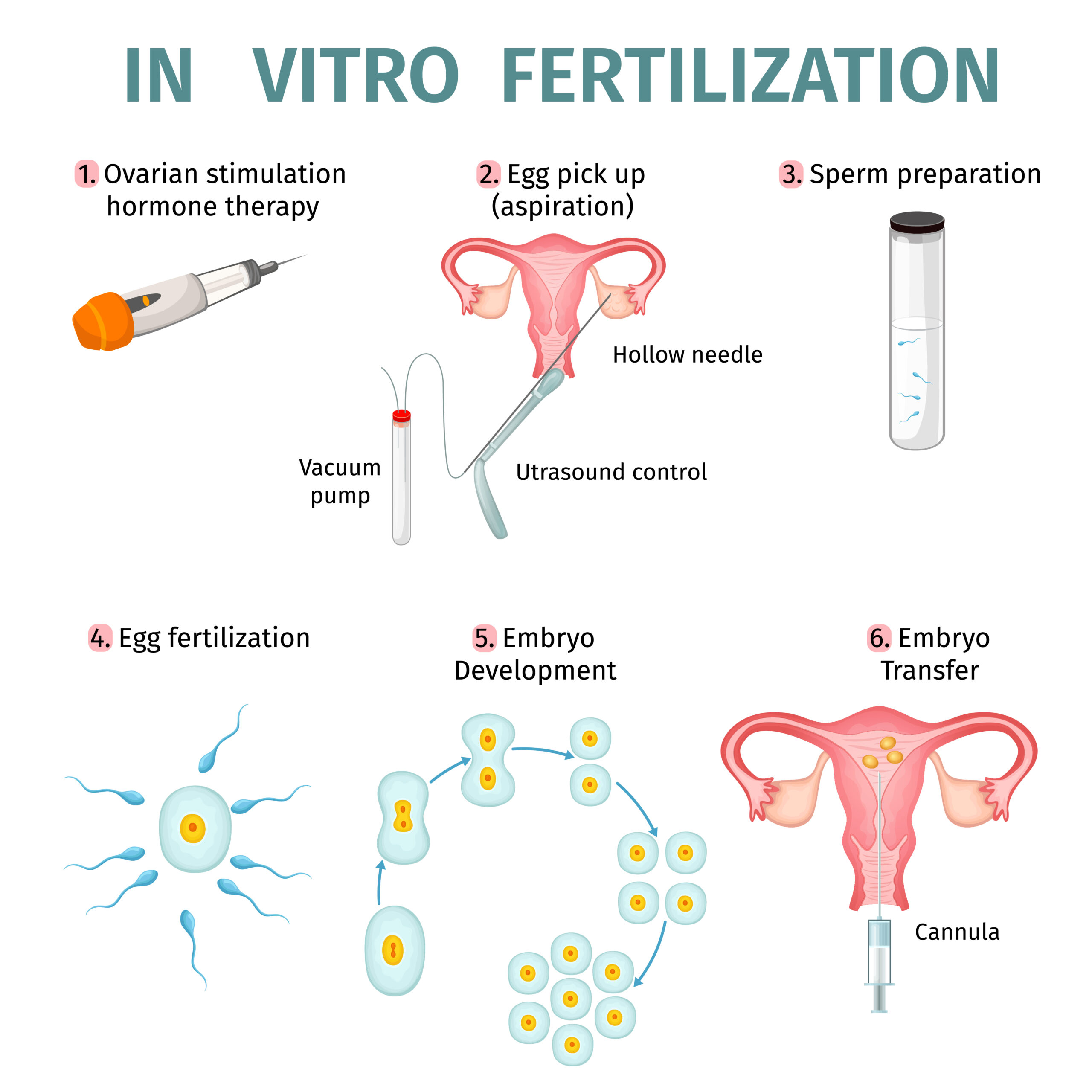 In Vitro Fertilization