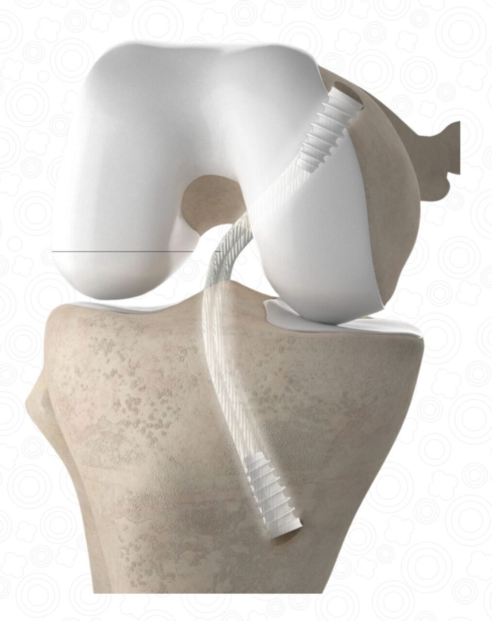 Pcl Rference Line PCL Surgery Posterior Cruciate Ligament In Bangalore