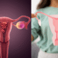 pcod and pcos