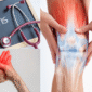 Arthritis
