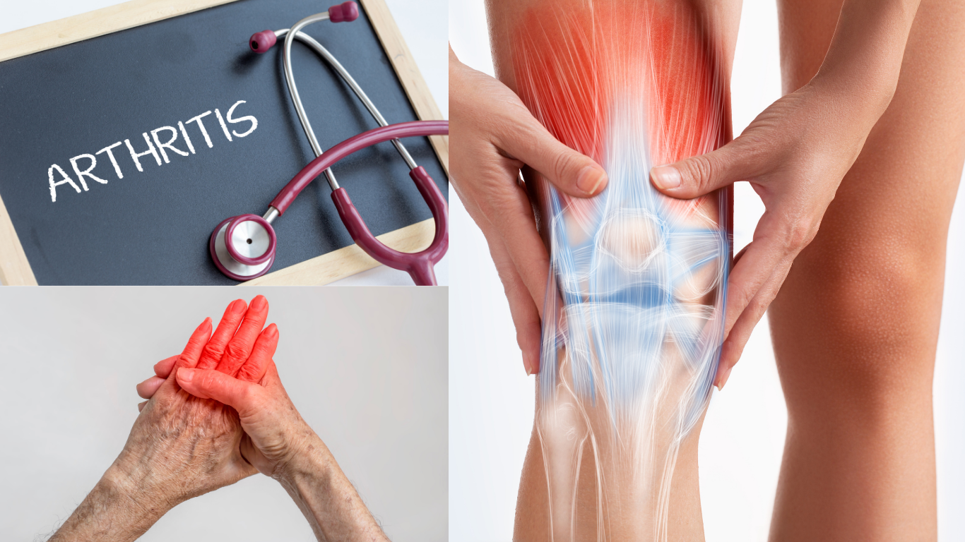 Arthritis
