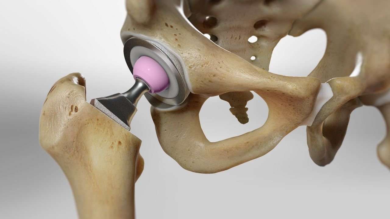 Illustration of an artificial hip joint for total hip replacement surgery