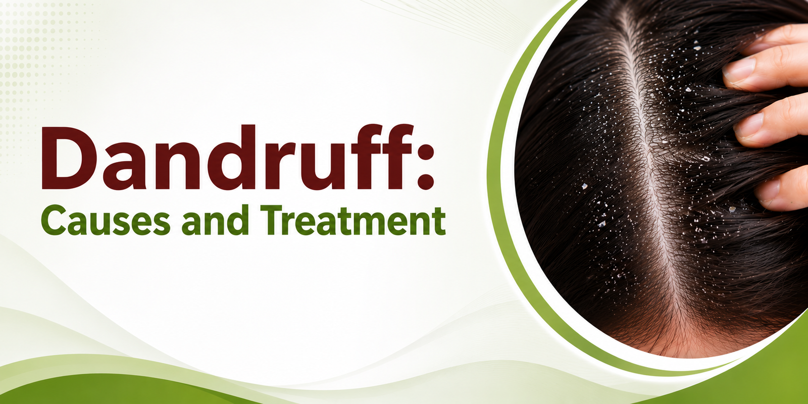Dandruff Causes and Treatment