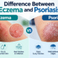 Eczema vs Psoriasis
